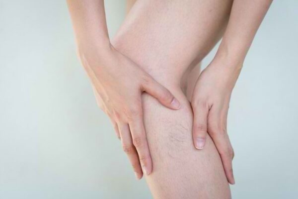Tips Tangani Varises untuk Kalian yang Sering Duduk Terlalu Lama